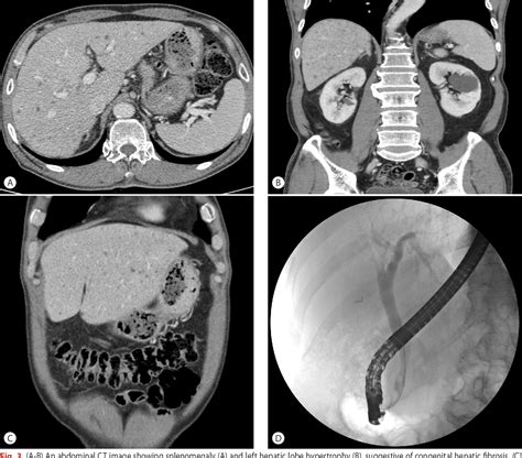 Figure 1 From A Case Of Combined Congenital Hepatic Fibrosis And