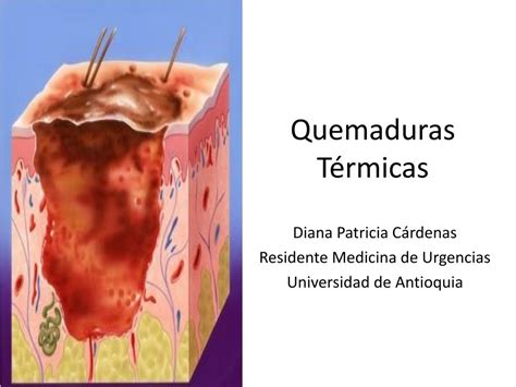 Ppt Quemaduras Térmicas Powerpoint Presentation Free Download Id