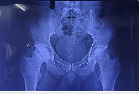 Preoperative X Ray Of The Patient Showing Avascular Necrosis Of The Download Scientific Diagram