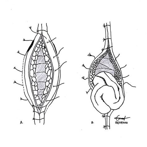 (PDF) Abdominal Wound Dehiscence: A Review of Risk Factors, Prevention and Management in ...