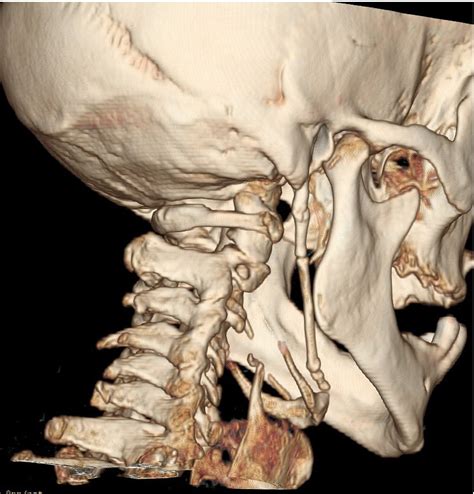 Eagle Syndrome Compared With Stylohyoid Syndrome Complete Ossification