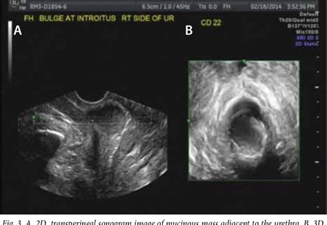 [PDF] Skene's gland duct cysts: The utility of vaginal/transperineal ...