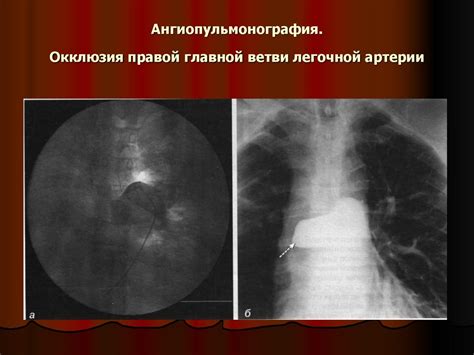 Легочное кровотечение - презентация онлайн