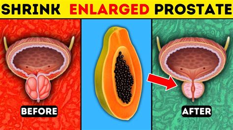 8 Fruits To Shrink An Enlarged Prostate Fullhealth Youtube