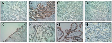 Immunohistochemical Expression Of Gnt V In Ovarian Carcinomas A