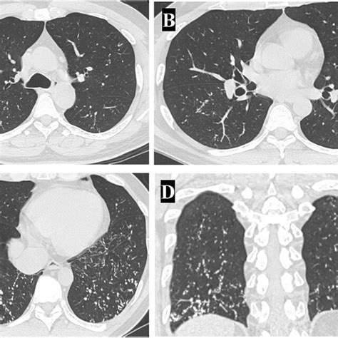 Three Different Computed Tomography Axial Cuts A C One Coronal Cut