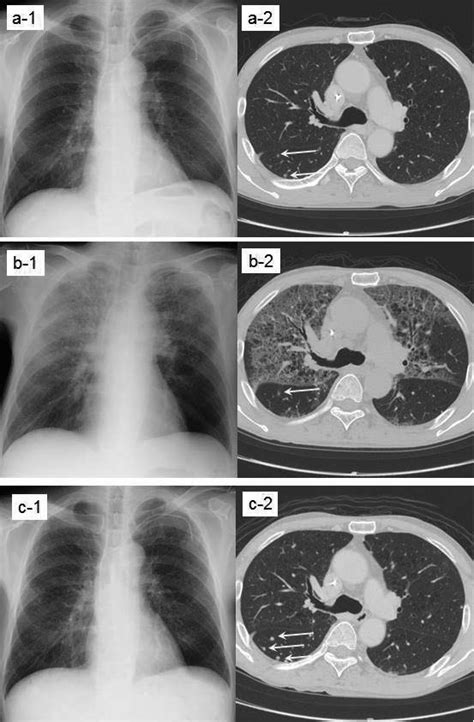 Chest X Ray Films And High Resolution Computed Tomography Scans Hrct