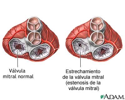 Opiniones de Estenosis mitral