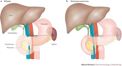 Laparoscopic Pancreatic Surgery For Benign And Malignant Disease