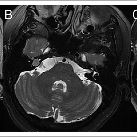 High Resolution Computed Tomography Hrct 1 Mm Section Bone