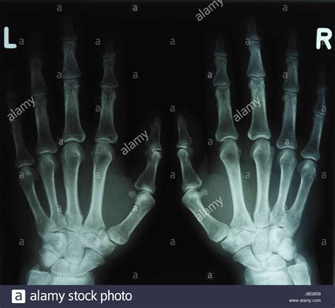 Rontgen Hand High Resolution Stock Photography and Images - Alamy