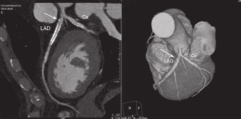 Computed tomography angiography five months after the Genous TM stent ...