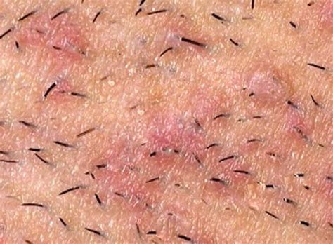 Infected Ingrown Hair - Pictures, Symptoms, Treatment, Removal