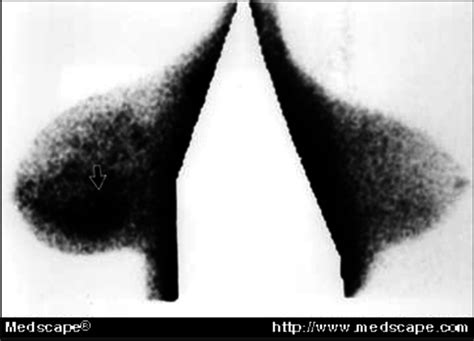 B Tc M Sestamibi Scintimammogram Of Left Breast Demonstrates Focal