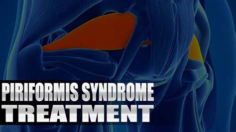 Piriformis Syndrome Treatment Chiropractor | El Paso, TX. | Video