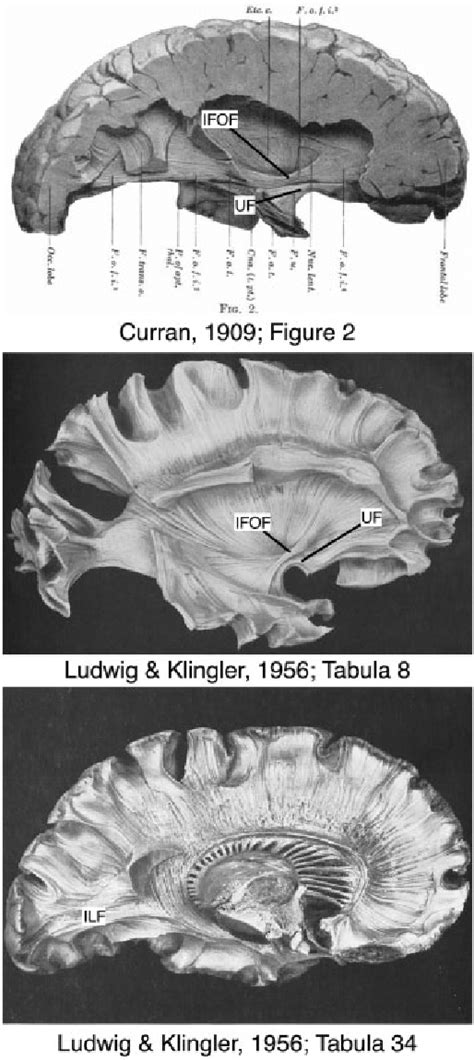 Blunt Fibre Dissection Of The Inferior Fronto Occipital Fasciculus