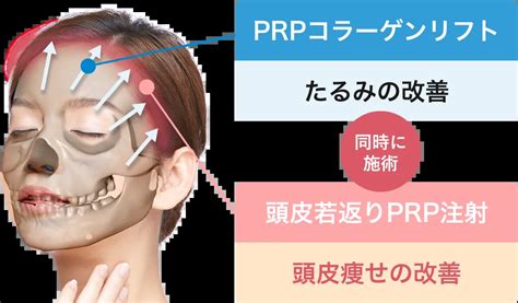 ポニーテールリフト Prp美容再生医療｜赤羽ウェルネスクリニック（東京）