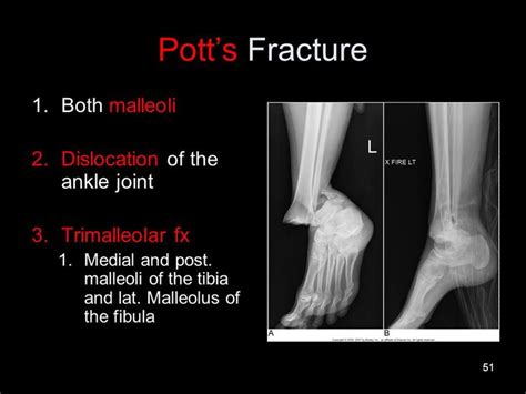 Image Result For Pott Fractures Sprained Ankle Ankle Joint Athletic