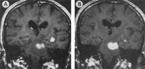 A Syphilitic Cerebral Gumma Manifesting As A Brain Stem Mass Lesion