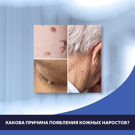 Какова причина появления кожных наростов? | Медицинский центр «АТЛАНТиК ...