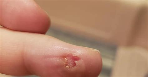 Had A Wart Frozen Off With Liquid Nitrogen Today The Blister Burst Imgur