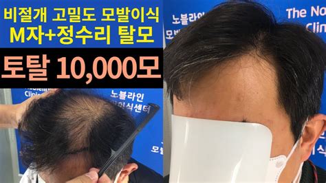 M자탈모정수리탈모 대량 모발이식 10000모4013모낭단위 13개월 경과 모발이식전후 비절개모발이식 Youtube