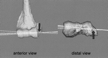 In Vivo Elbow Biomechanical Analysis During Flexion Three Dimensional