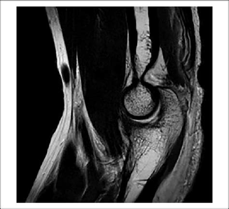 T2-weighted sagittal MRI showed full-thickness tear of the distal... | Download Scientific Diagram