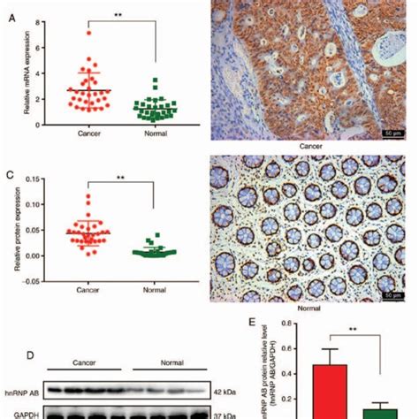 Hnrnp Ab Mrna And Protein Expression Is Upregulated In Crc Tissues A