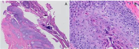 Erythema Multiforme Oral Histology