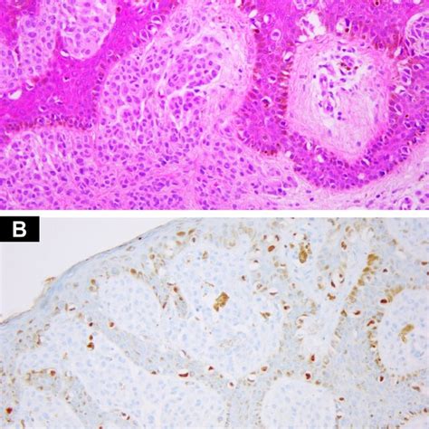 A Acral Lentiginous Melanoma In Situ With Adnexotropism Download