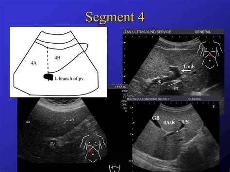 Liver Segments On Ultrasound Ppt