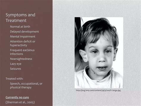 Ho Fragile X Syndrome Ppt