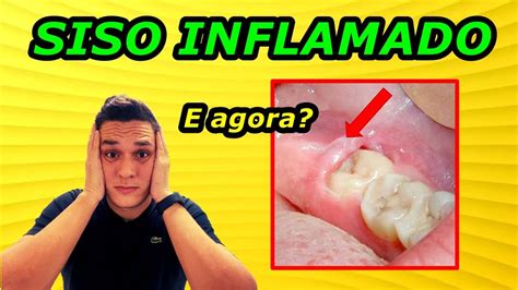 Dente Do Siso Inflamado O Que Fazer Rem Dios Caseiros