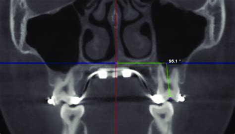 measurement  dental tipping angle   molar   measuring