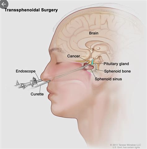 Tratamento Adenoma de Hipófise Porto Alegre Neurocirurgia CEANNE