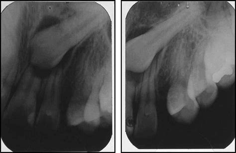 References In Complications Of Misdiagnosis Of Maxillary Canine Ectopic