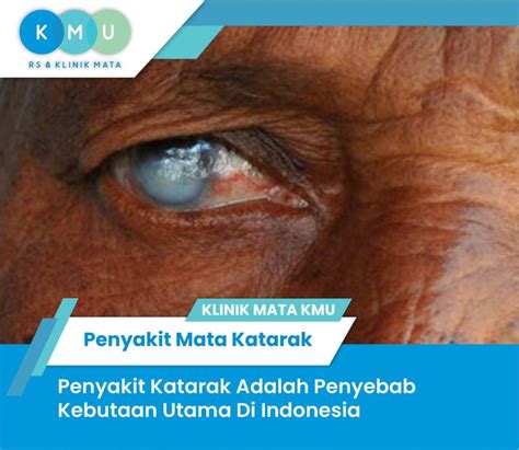 Waspada Katarak Adalah Penyebab Kebutaan No Di Indonesia