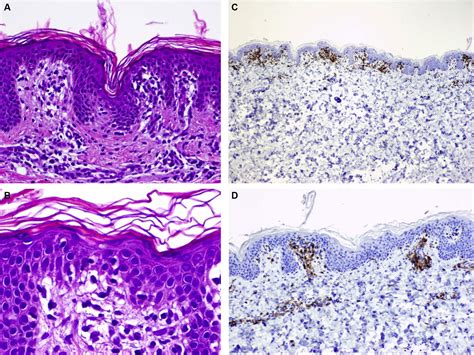 Annular Lichenoid Dermatitis Of Youth A Report Of 2 Cases And A Review