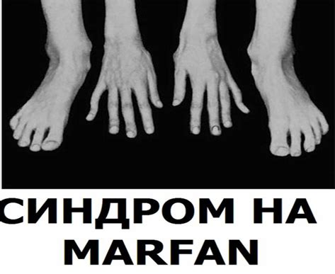 Синдром на Марфан - БГ Наука