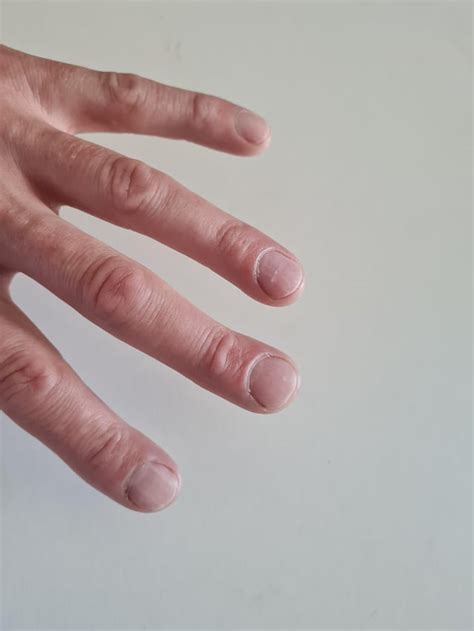 Clubbed Fingers Causes Symptoms And Treatment Okedin