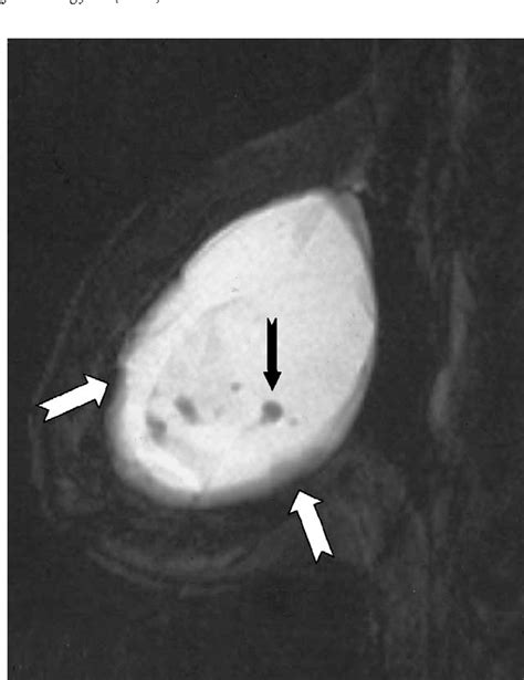 PDF The Diagnosis Of Breast Implant Rupture MRI Findings Compared