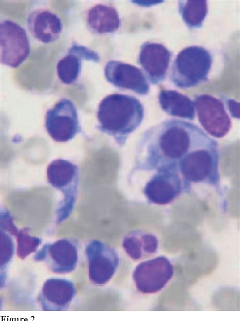 Figure 1 From Multiple Myeloma Amyloidosis Presenting As Pseudomyopathy