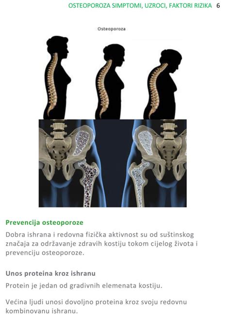 Osteoporoza Simptomi Uzroci Faktori Rizika JZU Dom Zdravlja Prnjavor