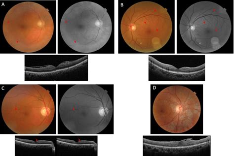 Diabetic Retinopathy Screening Integrated In A Multidisciplinary Diabetes Care Clinic A Pilot