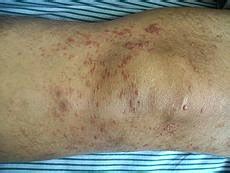 Mycosis Fungoides Symptoms And Treatment | Health And Beauty