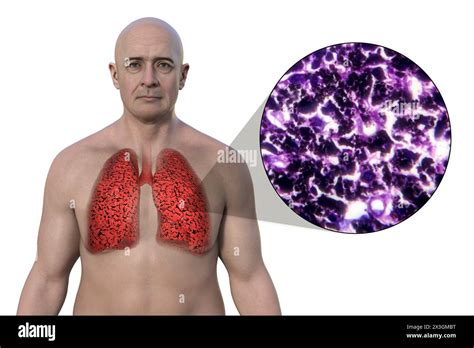 Illustration Of A Man With Smoker S Lungs Along With A Micrograph