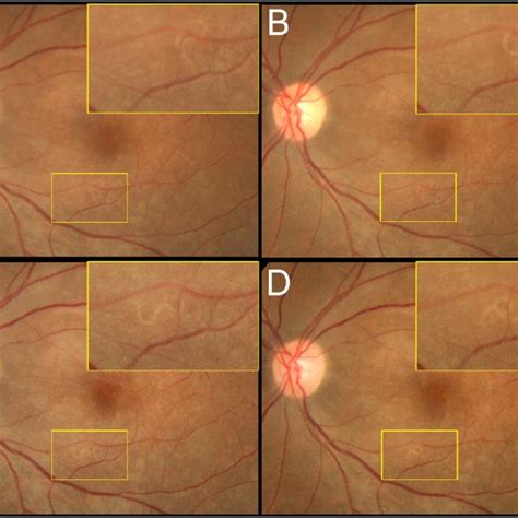 A Enface Swept Source Vitreous Oct Approximately M Above The