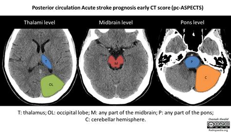 Posterior Circulation Ischaemic Stroke Imaging Correlates And