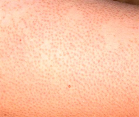 Keratosis Pilaris Pictures Symptoms Causes Treatment Hubpages